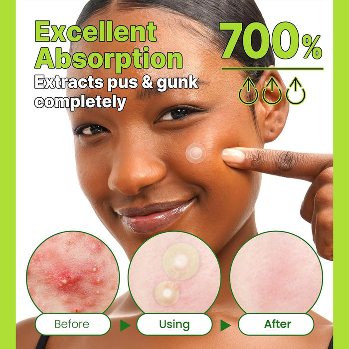 Troubless Invisible Plus Spot Patch The Red Correct 98% Tea Tree 96 Patches