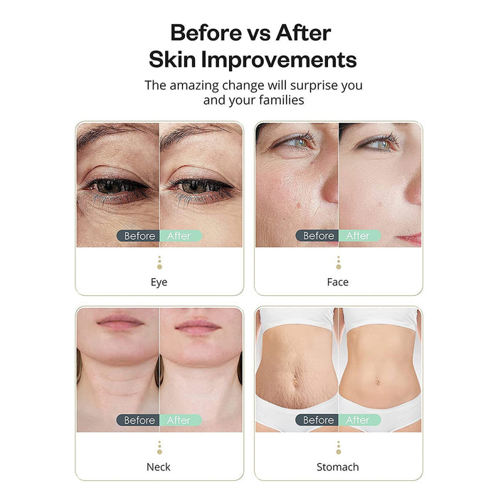 High Frequency Skin Tightening Machine for Face & Neck & Body - ikatehouse